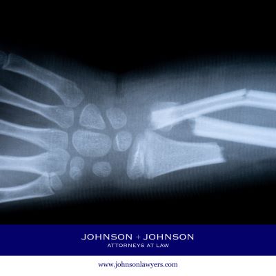 An X-ray image showing a broken wrist and forearm injury after a personal injury accident in Pine Ridge, SC