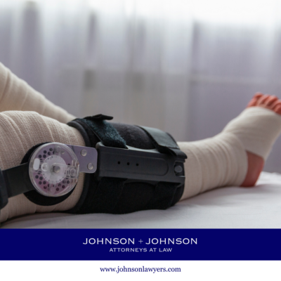 The broken leg of a Red Bank, SC personal injury victim