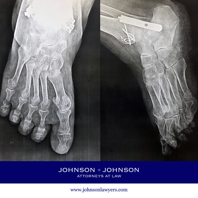 X-ray of a Newberry, SC accident victim after a severe ankle fracture, with visible orthopedic bone plate and pins